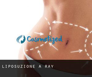 Liposuzione a Ray